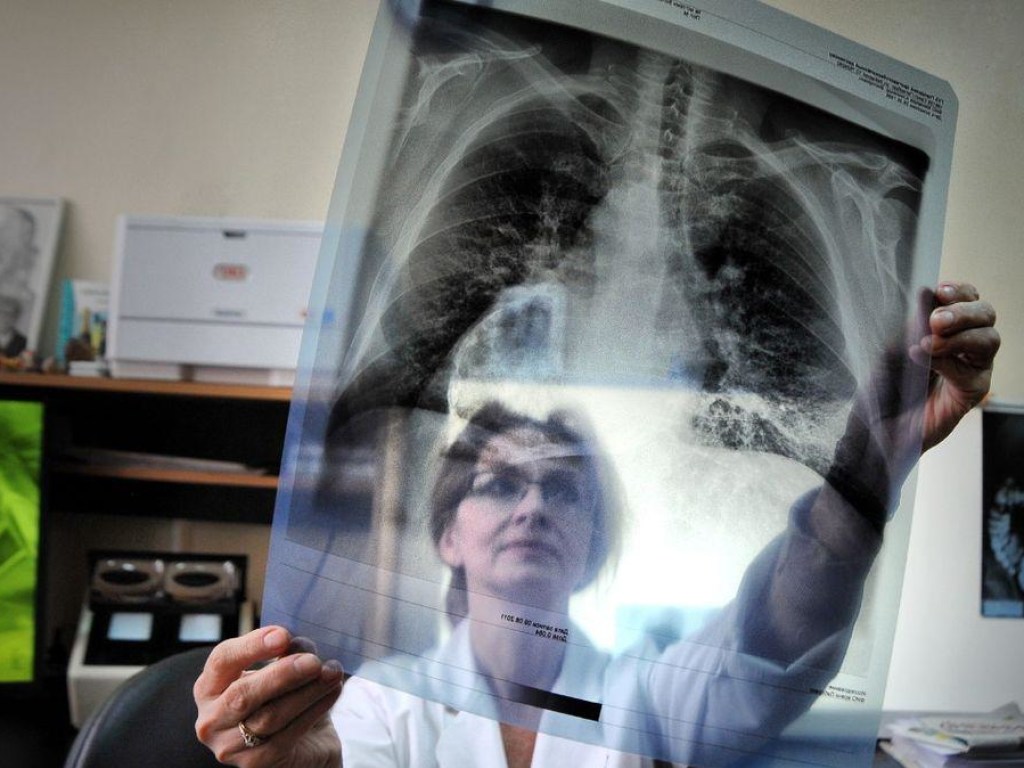 «Эпидемия  в Украине»:  мультирезистентный туберкулез хуже, чем коронавирус  &#8212; эксперт
