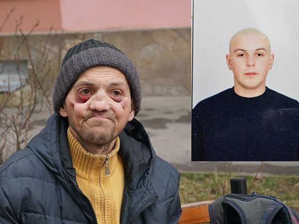 Парень за два года превратился в старика из-за наркотиков: фото «до» и «после»