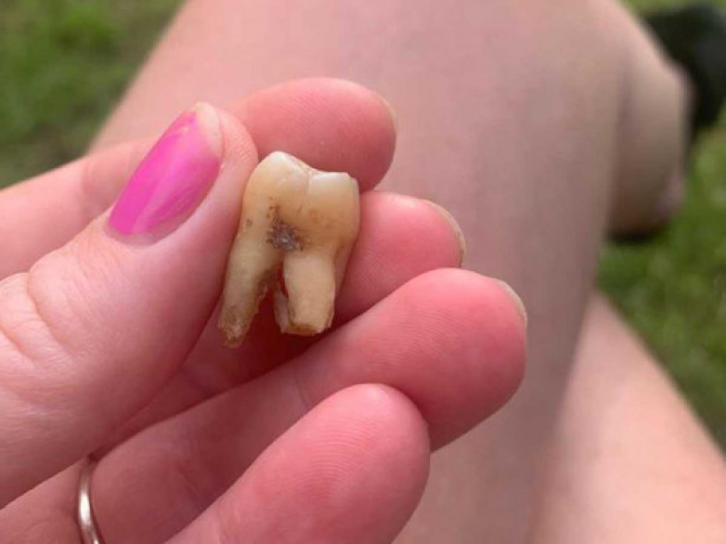Ужасы карантина: люди начали сами вырывать себе больные зубы (ФОТО)