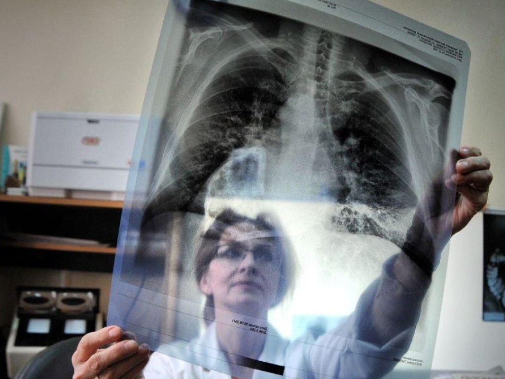 Ученые предупредили о глобальной вспышке туберкулеза из-за карантина