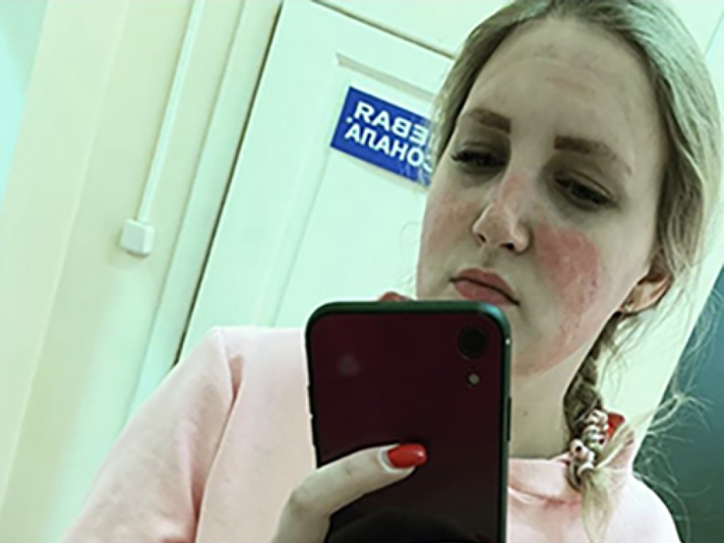 У медсестры появились огромные химические ожоги из-за ношения медицинской маски (ФОТО)