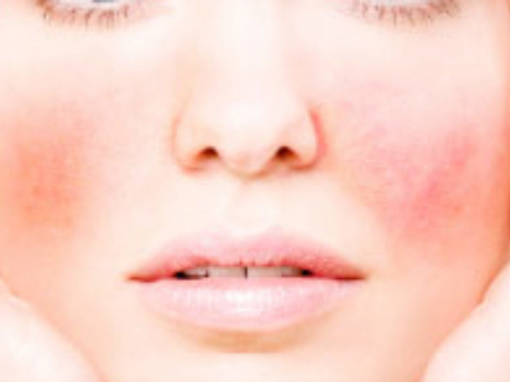 «Сеточка капилляров на лице»: врач рассказал, из-за каких заболеваний это происходит
