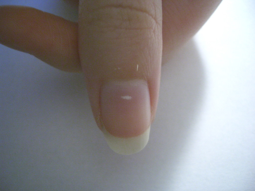 «Не очень хорошая примета»: врач предупредила об опасности белых пятен на ногтях
