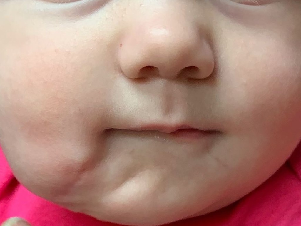 У новорожденной было два рта: в США провели уникальную пластическую операцию у 6-месячного малыша (ФОТО)