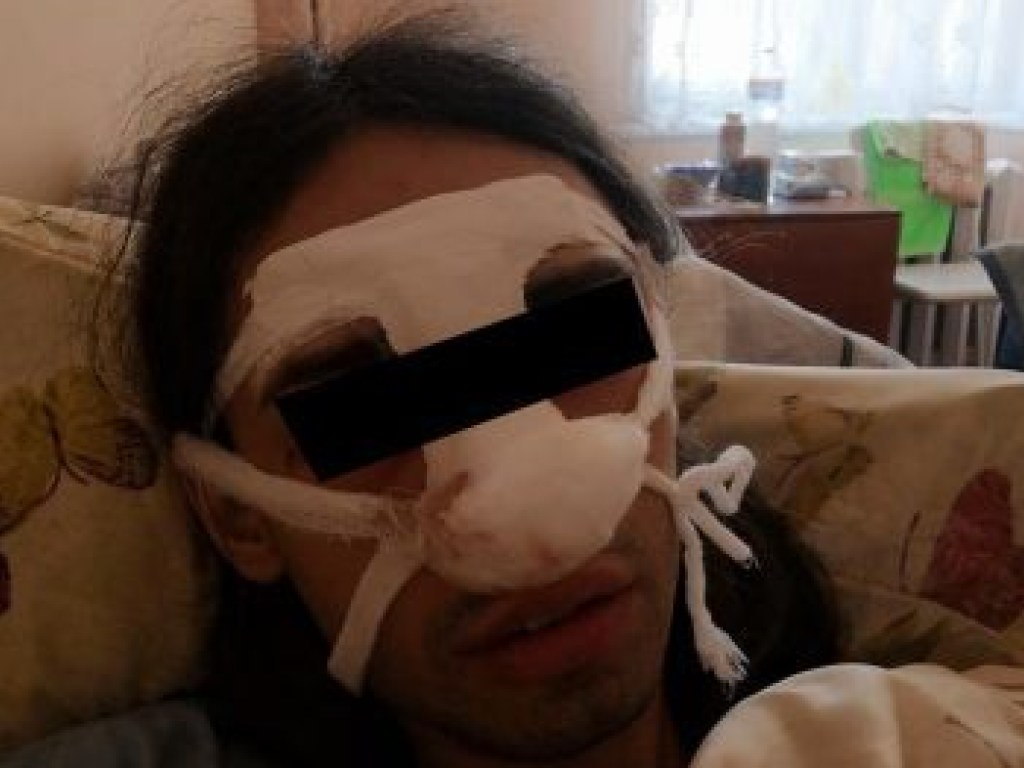 Сломали нос: В Харькове трое мужчин напали на трансгендерную женщину (ФОТО)