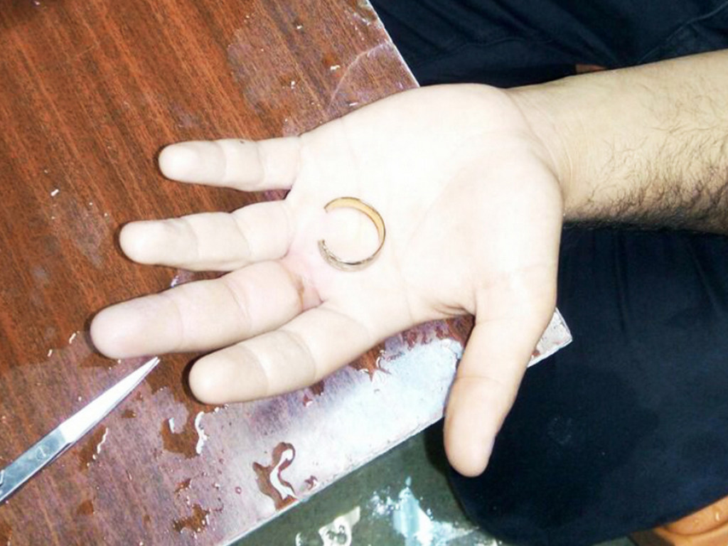 С помощью спасателей у мужчины в Днепре сняли кольцо с пальца (ФОТО)