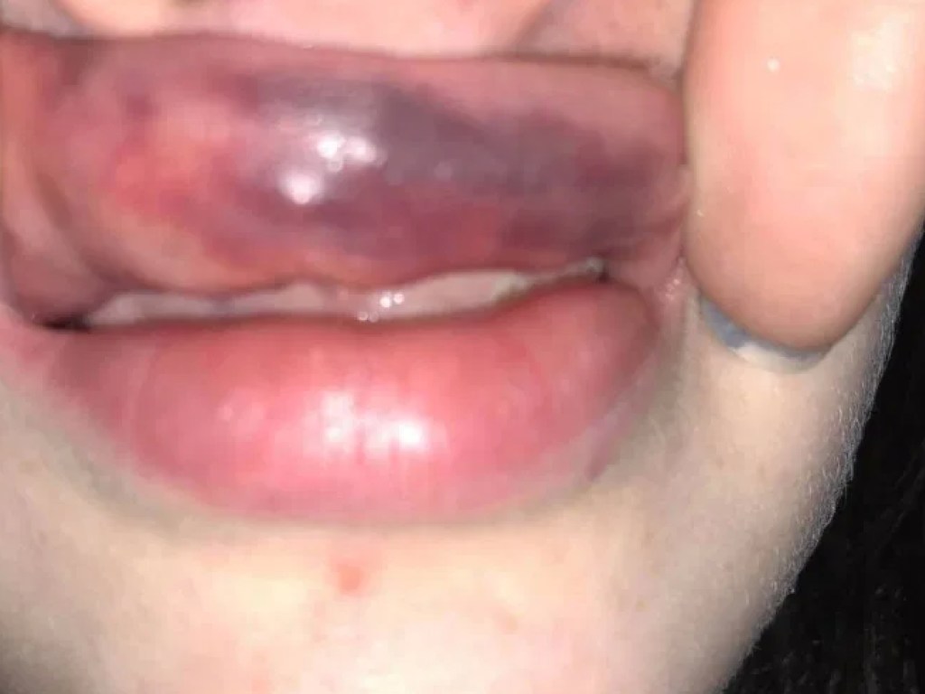Пластический хирург в Шотландии изуродовал губы девушке и занес опасную болезнь (ФОТО)
