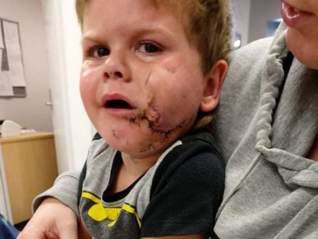 Двухлетний мальчик не поделил с собакой еду и потерял половину лица (ФОТО)