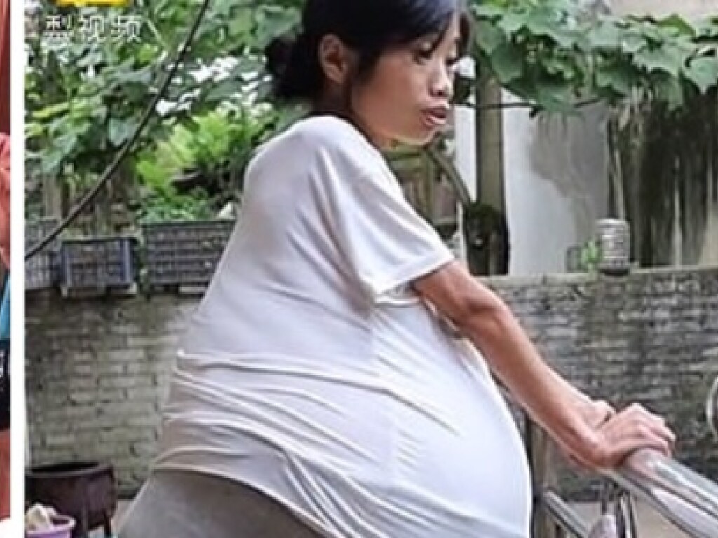 У 36-летней китаянки из-за неизвестного заболевания вырос огромный живот (ФОТО)