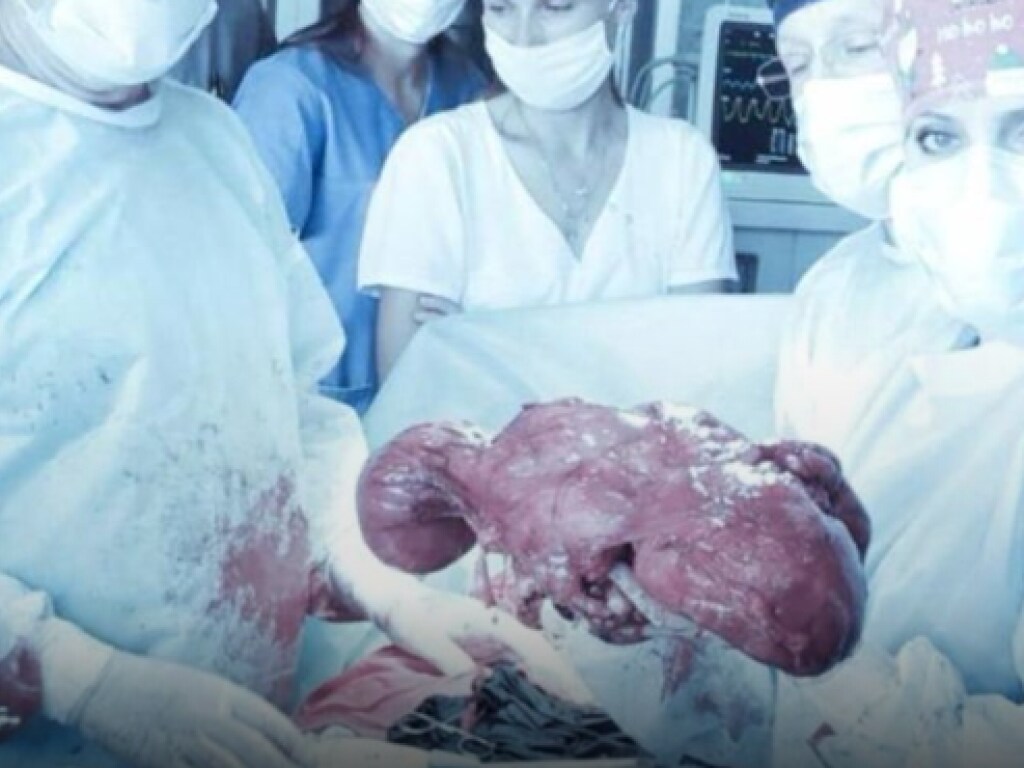 Во Львове врачи удалили женщине 10–килограммовую опухоль, которая вросла в почку (ФОТО)