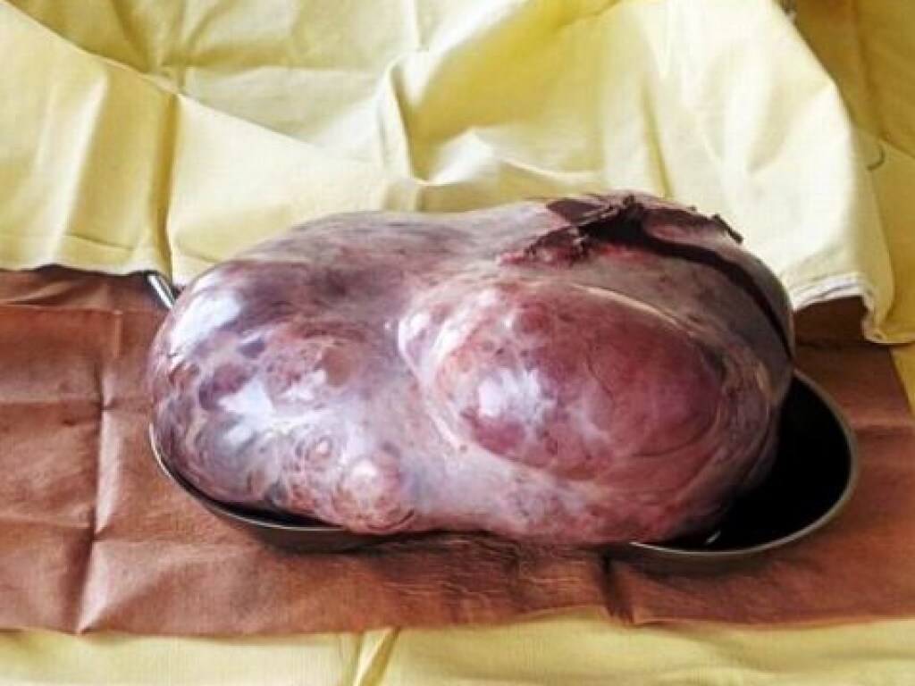 Хирурги на Волыни удалили девочке гигантскую опухоль в 3 кило (ФОТО)
