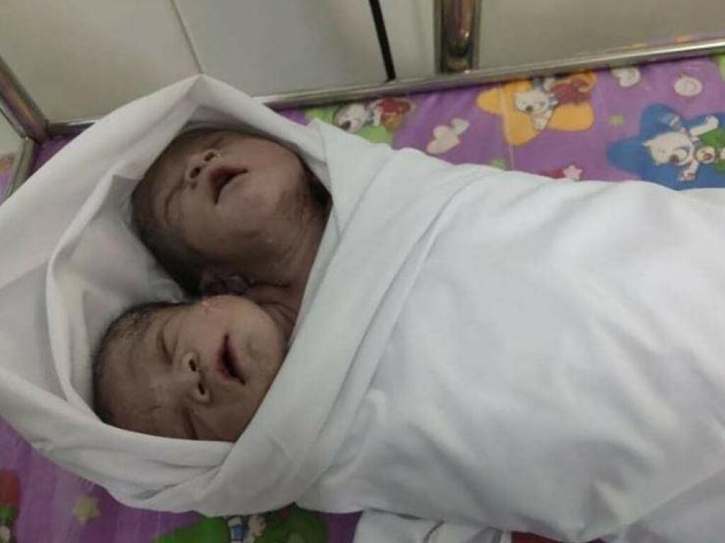 Жительница Мьянмы родила ребенка с двумя головами (ФОТО)