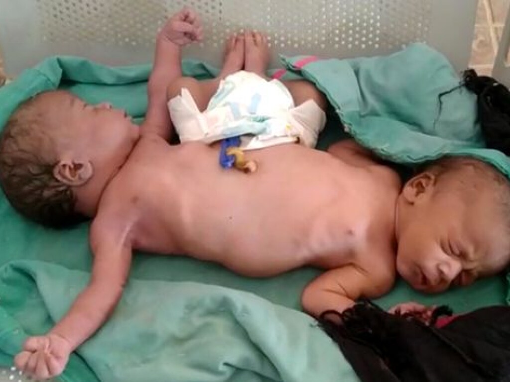 У жительницы Индии родились сиамские близнецы с двумя ногами и четырьмя руками (ФОТО)