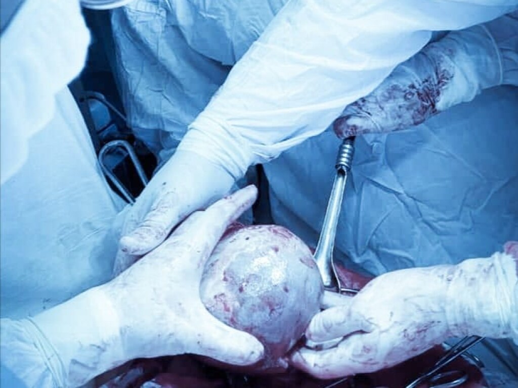 Во Львове врачи провели уникальную операцию: удалили женщине полуторакилограммовую кисту (ФОТО)